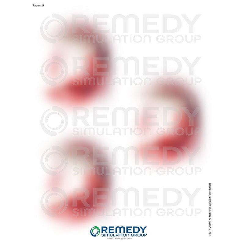 Wallcur-Moulage Tattoos - Patient U Scenario-MedTech-1